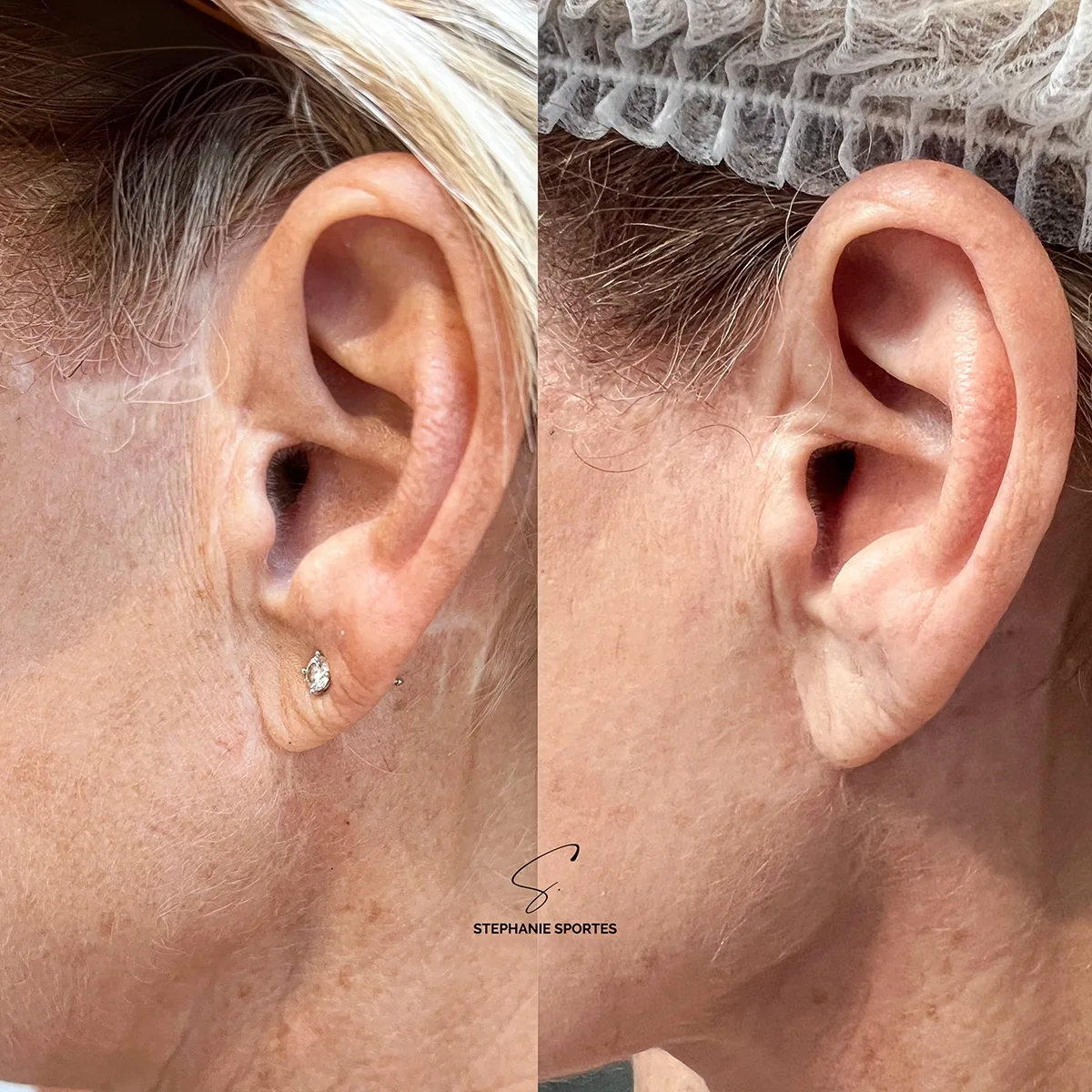 Cicatrice traitée par dermopigmentation réparatrice