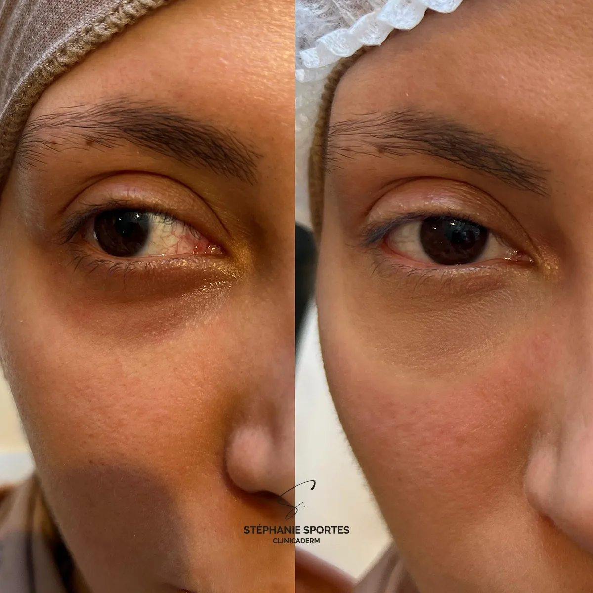 Dermopigmentation correctrice des cernes