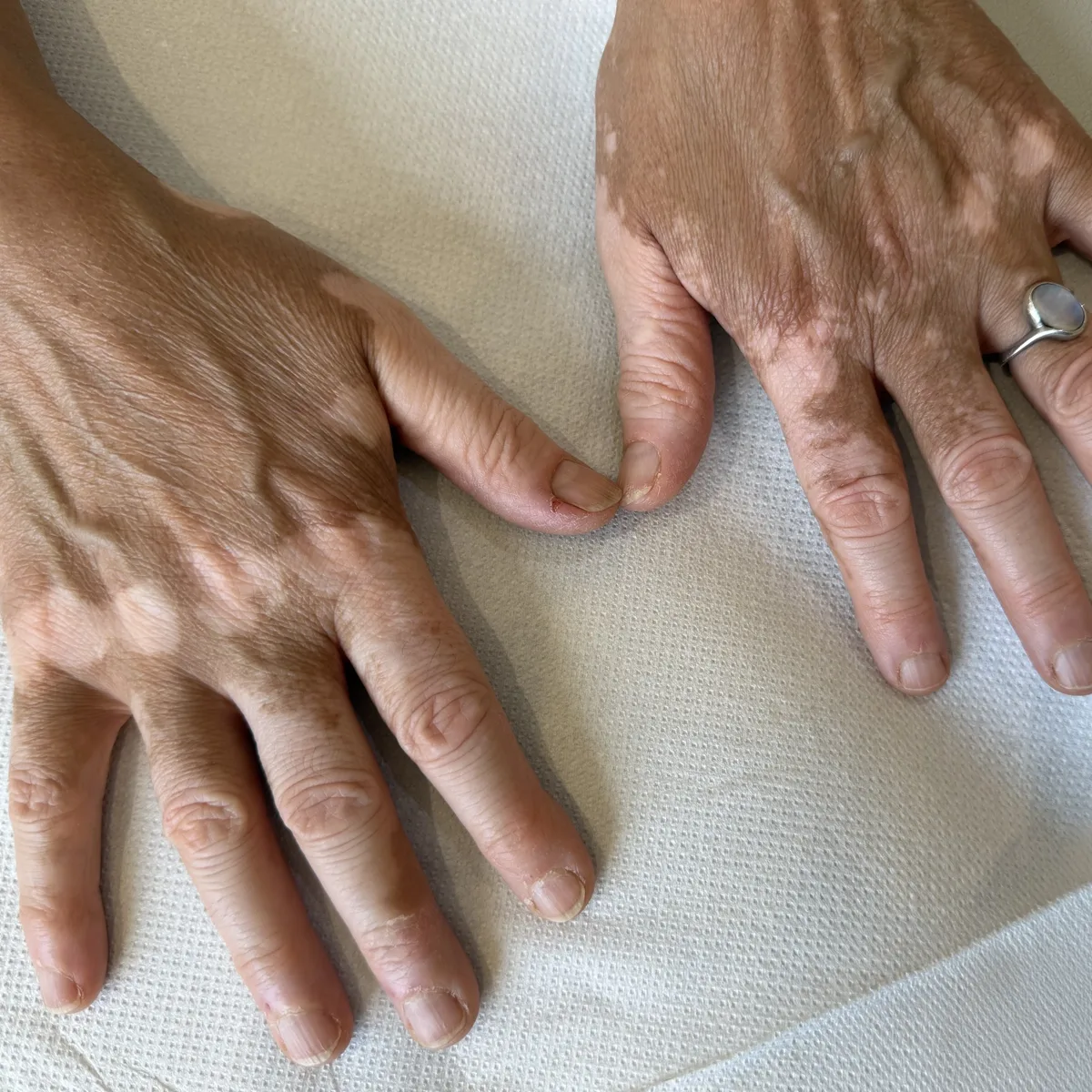 Dermopigmentation réparatrice du vitiligo