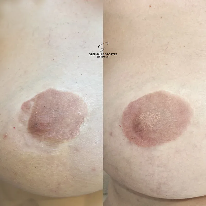 Hypopigmentation aréolaire