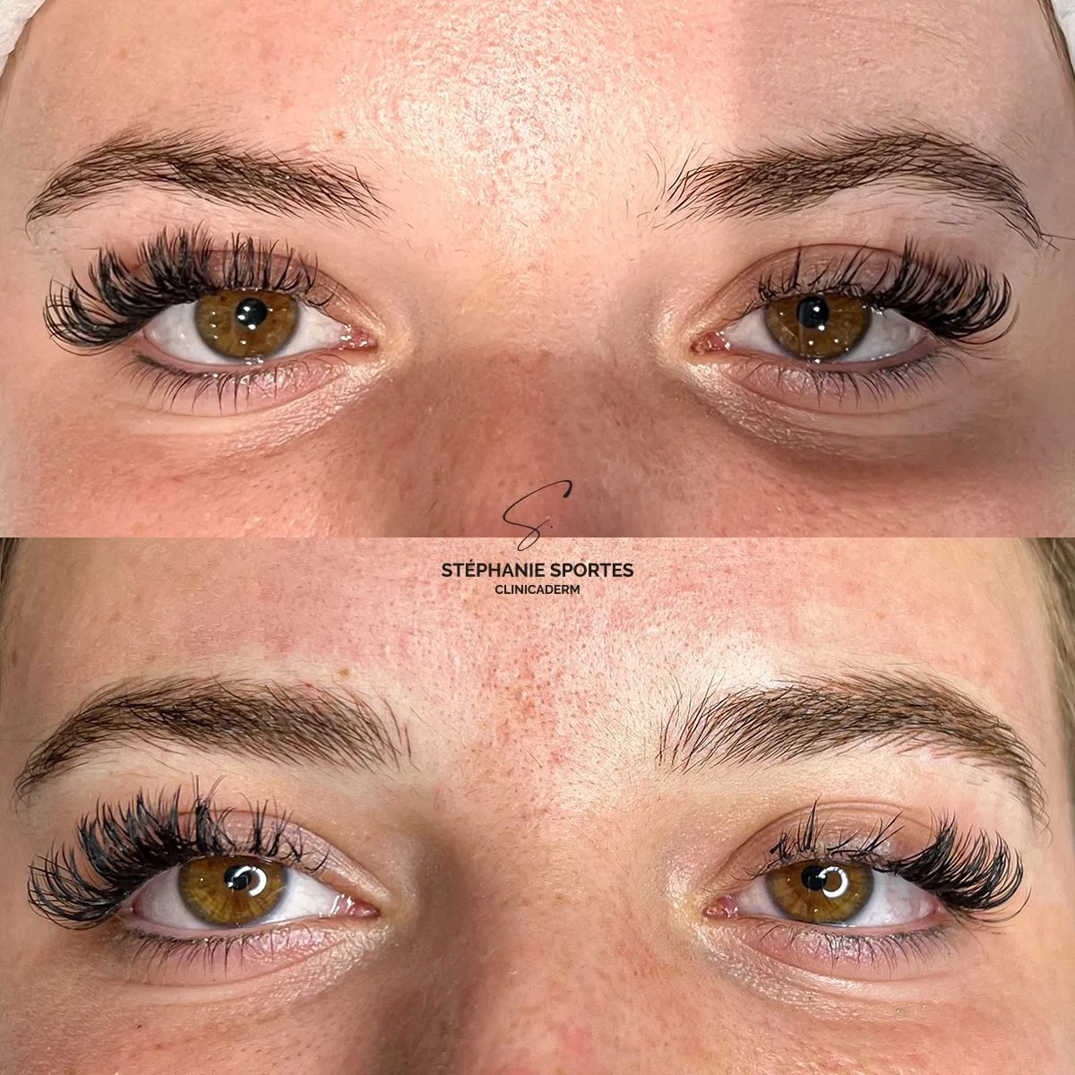 Sourcils restaurés par microblading