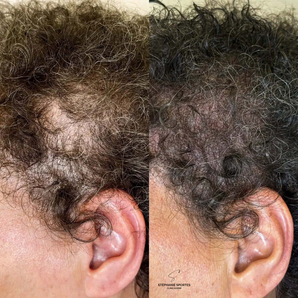 Tricopigmentation du cuir chevelu, résultat 1