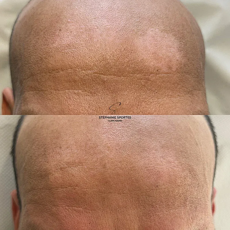 Vitiligo du cuir chevelu
