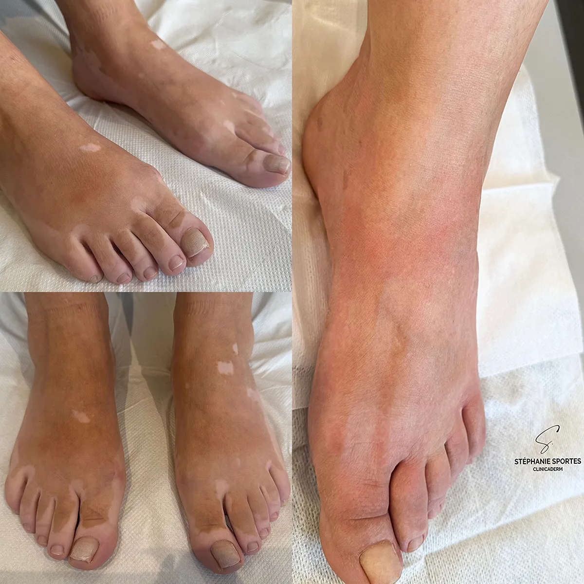Vitiligo, extrémités