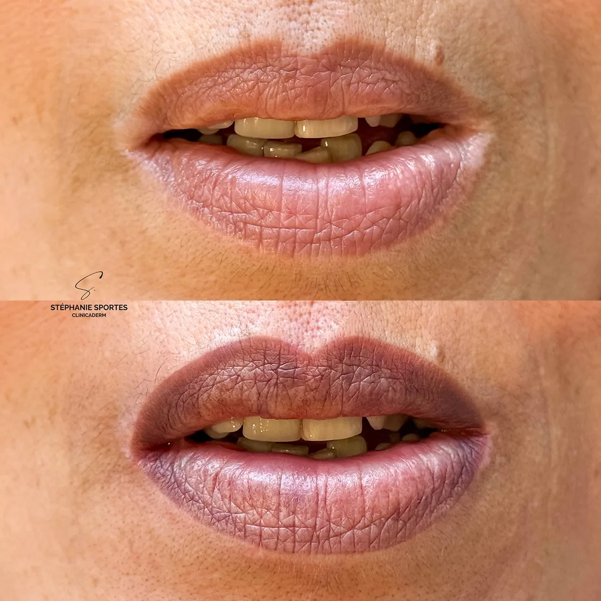 Vitiligo labial, périphérie des commissures