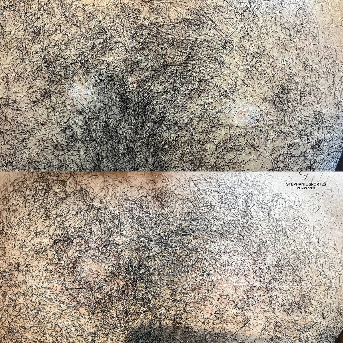 Vitiligo, zone pileuse